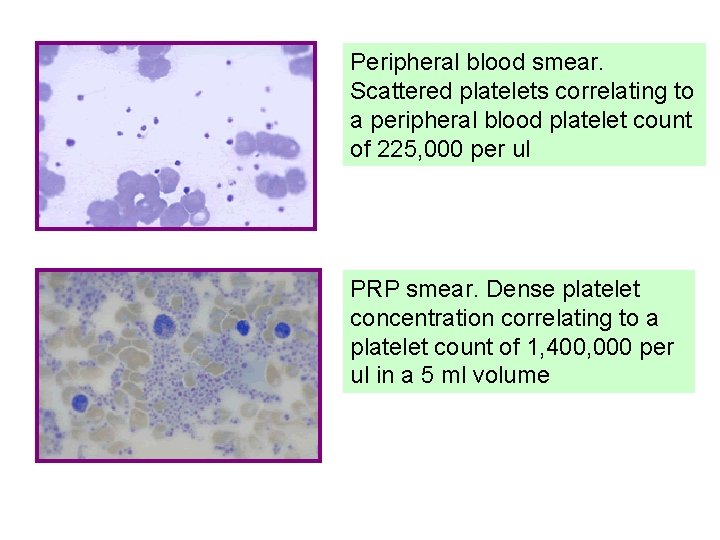 Peripheral blood smear. Scattered platelets correlating to a peripheral blood platelet count of 225,