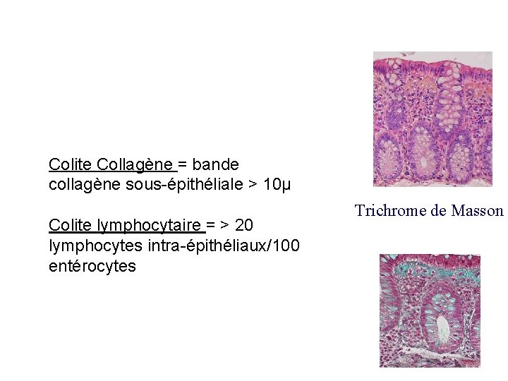 Colite collagène Colite Collagène = bande collagène sous-épithéliale > 10µ Colite lymphocytaire = >