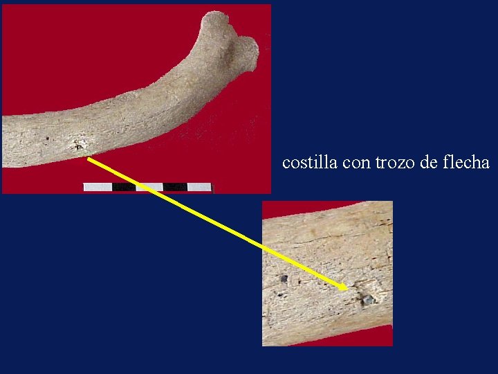 costilla con trozo de flecha 