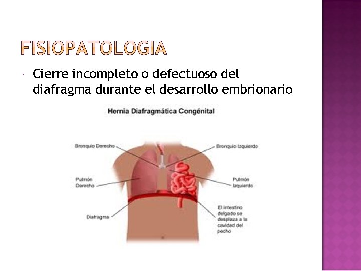  Cierre incompleto o defectuoso del diafragma durante el desarrollo embrionario 