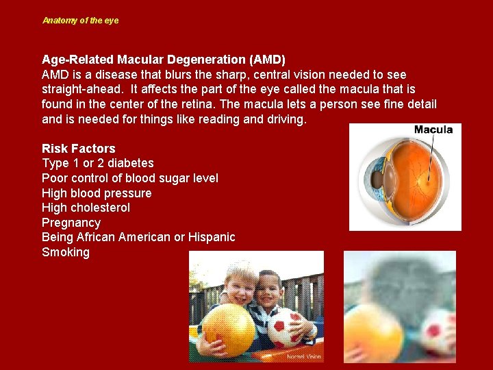 Anatomy of the eye Age-Related Macular Degeneration (AMD) AMD is a disease that blurs
