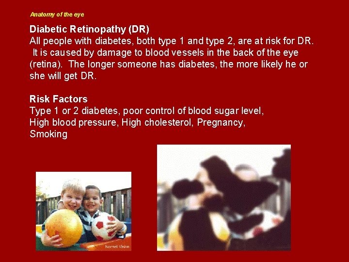 Anatomy of the eye Diabetic Retinopathy (DR) All people with diabetes, both type 1