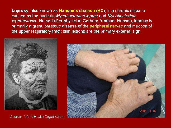 Leprosy, also known as Hansen's disease (HD), is a chronic disease caused by the