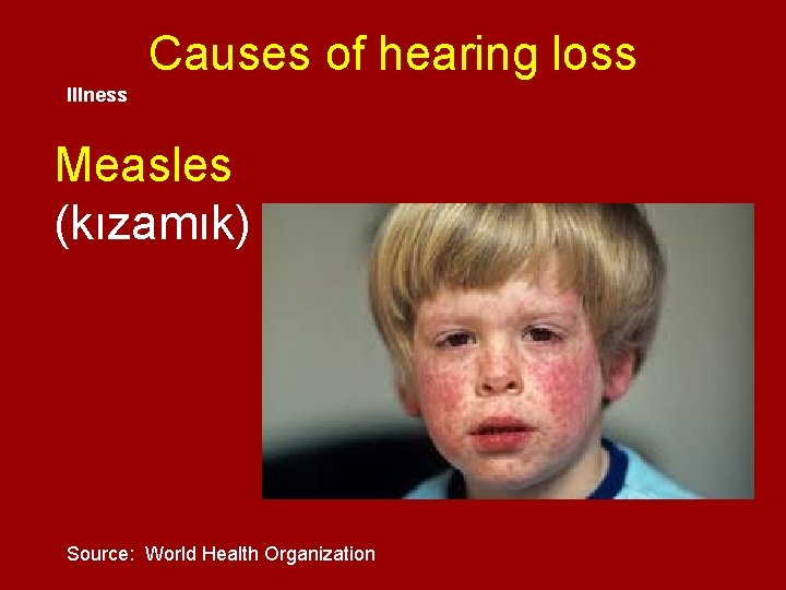 Causes of hearing loss Illness Measles (kızamık) Source: World Health Organization 