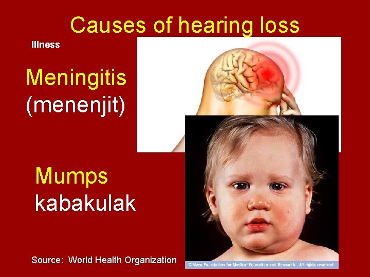 Causes of hearing loss Illness Meningitis (menenjit) Mumps kabakulak Source: World Health Organization 