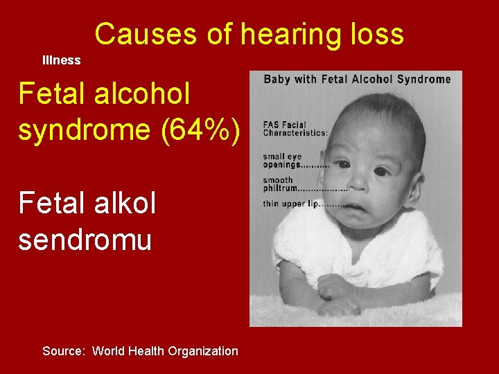 Causes of hearing loss Illness Fetal alcohol syndrome (64%) Fetal alkol sendromu Source: World