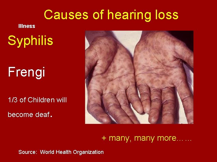 Causes of hearing loss Illness Syphilis Frengi 1/3 of Children will become deaf .