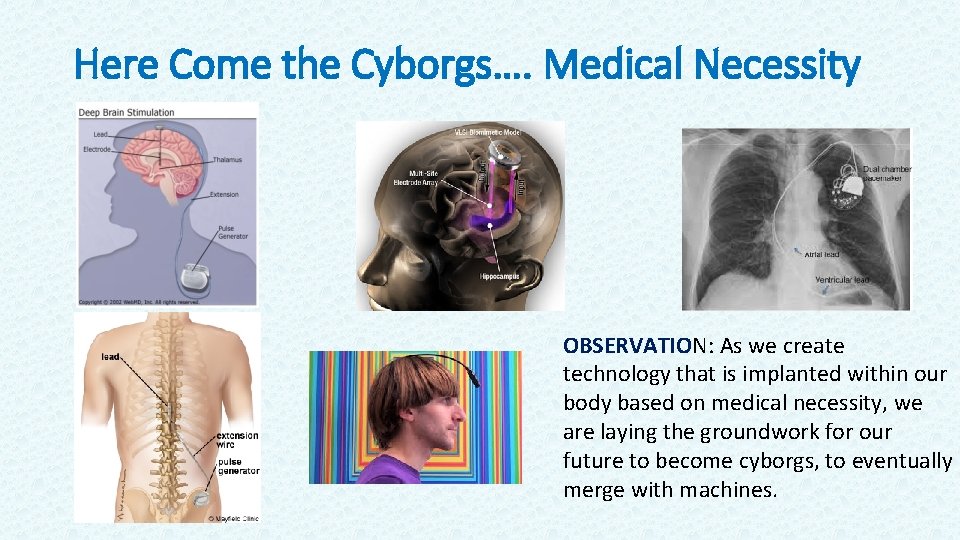 Here Come the Cyborgs…. Medical Necessity OBSERVATION: As we create technology that is implanted