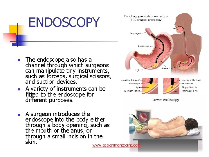 ENDOSCOPY n n n The endoscope also has a channel through which surgeons can