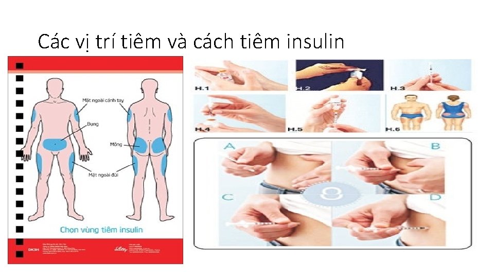 Các vị trí tiêm và cách tiêm insulin • . : 