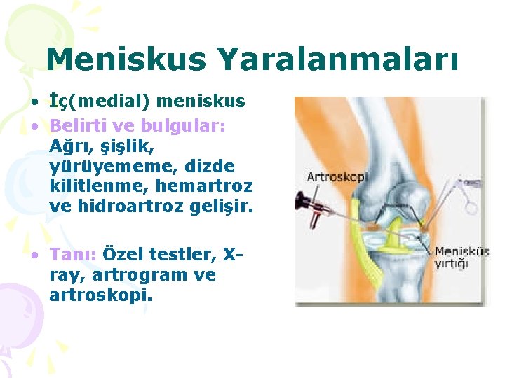 Meniskus Yaralanmaları • İç(medial) meniskus • Belirti ve bulgular: Ağrı, şişlik, yürüyememe, dizde kilitlenme,