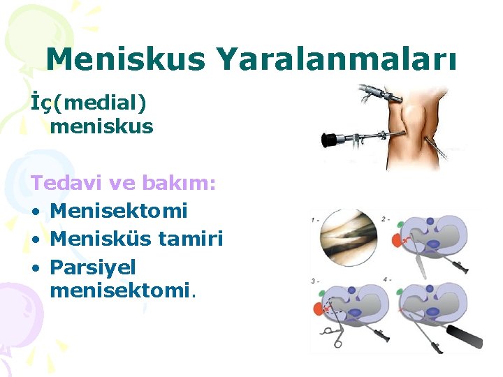 Meniskus Yaralanmaları İç(medial) meniskus Tedavi ve bakım: • Menisektomi • Menisküs tamiri • Parsiyel