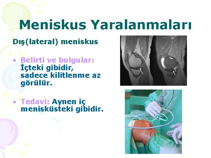 Meniskus Yaralanmaları Dış(lateral) meniskus • Belirti ve bulgular: İçteki gibidir, sadece kilitlenme az görülür.