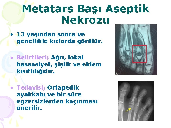 Metatars Başı Aseptik Nekrozu • 13 yaşından sonra ve genellikle kızlarda görülür. • Belirtileri;