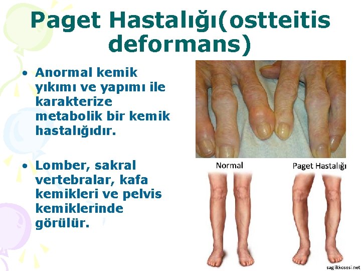 Paget Hastalığı(ostteitis deformans) • Anormal kemik yıkımı ve yapımı ile karakterize metabolik bir kemik