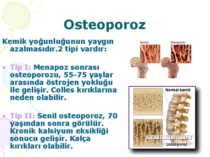 Osteoporoz Kemik yoğunluğunun yaygın azalmasıdır. 2 tipi vardır: • Tip I: Menapoz sonrası osteoporozu,