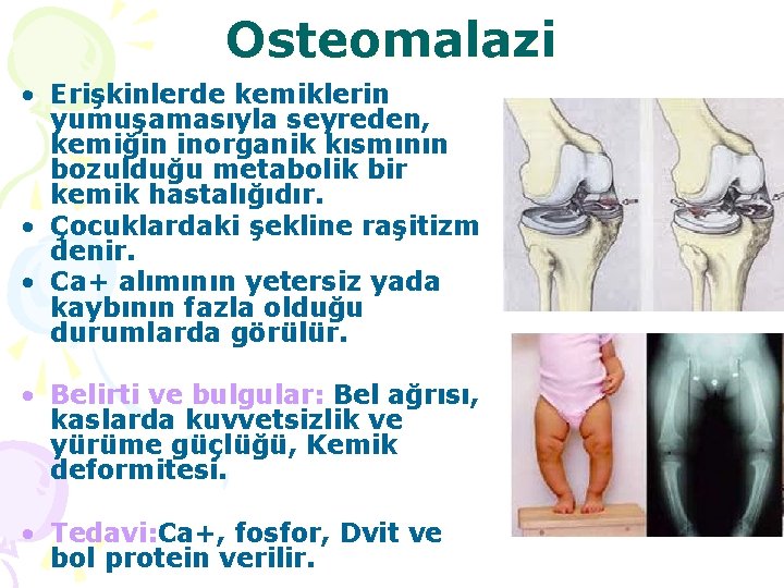 Osteomalazi • Erişkinlerde kemiklerin yumuşamasıyla seyreden, kemiğin inorganik kısmının bozulduğu metabolik bir kemik hastalığıdır.