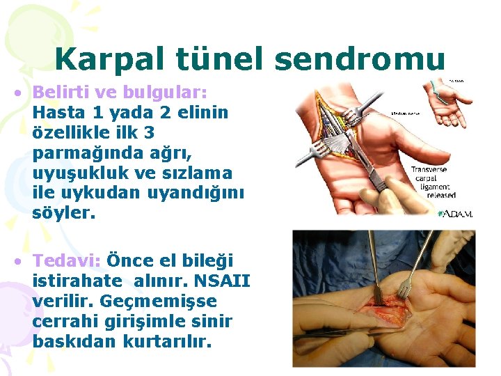 Karpal tünel sendromu • Belirti ve bulgular: Hasta 1 yada 2 elinin özellikle ilk