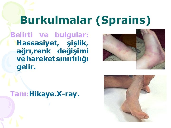 Burkulmalar (Sprains) Belirti ve bulgular: Hassasiyet, şişlik, ağrı, renk değişimi ve hareket sınırlılığı gelir.