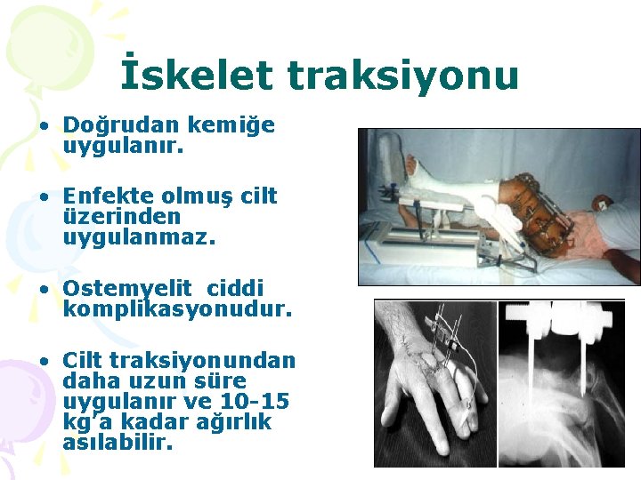 İskelet traksiyonu • Doğrudan kemiğe uygulanır. • Enfekte olmuş cilt üzerinden uygulanmaz. • Ostemyelit