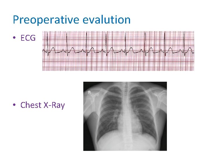 Preoperative evalution • ECG • Chest X-Ray 