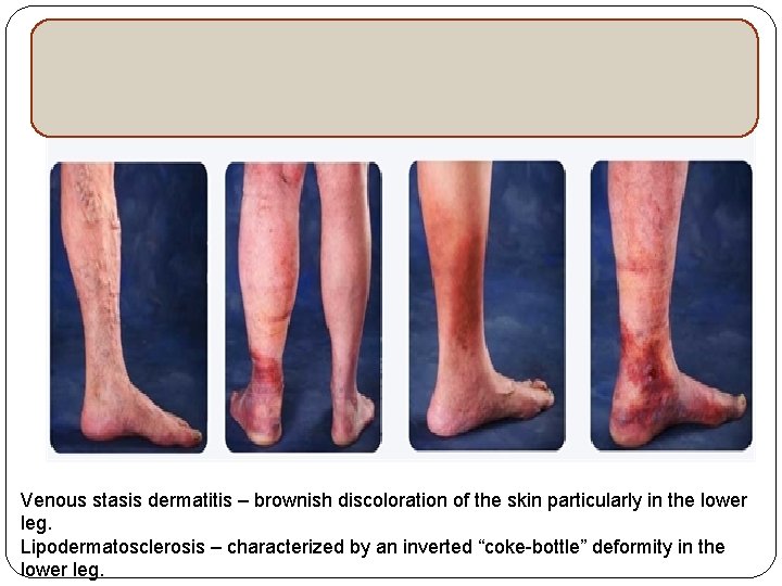 Chronic venous insufficiency Venous stasis dermatitis – brownish discoloration of the skin particularly in