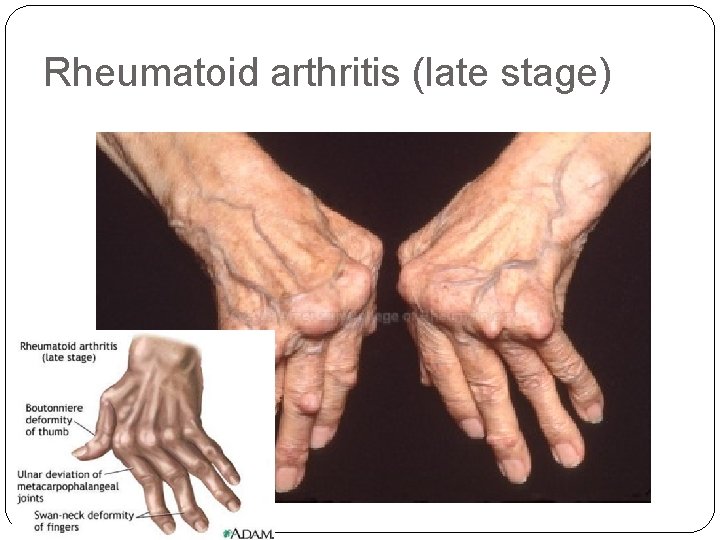 Rheumatoid arthritis (late stage) 