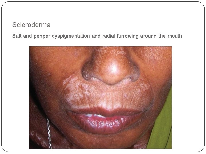 Scleroderma Salt and pepper dyspigmentation and radial furrowing around the mouth 