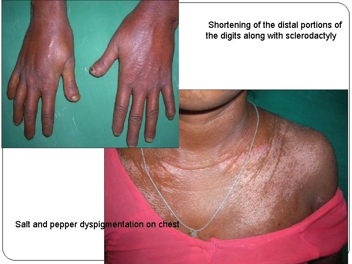 t Salt and pepper dyspigmentation on chest Shortening of the distal portions of the