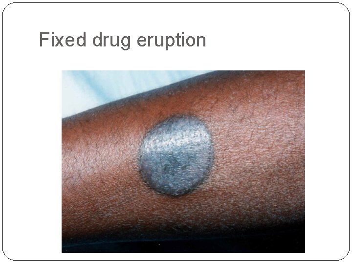 Fixed drug eruption 