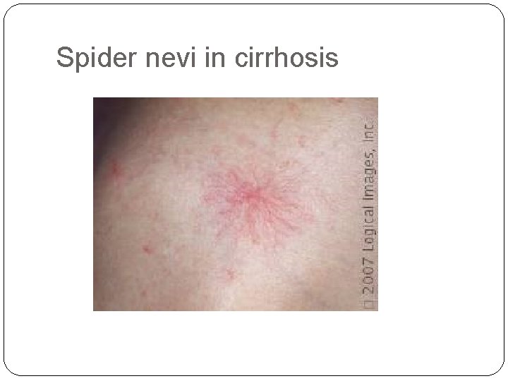 Spider nevi in cirrhosis 