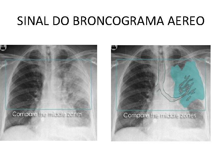 SINAL DO BRONCOGRAMA AEREO 