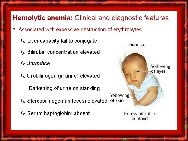 Hemolytic anemia: Clinical and diagnostic features • Associated with excessive destruction of erythrocytes Liver