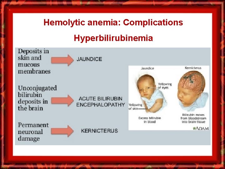 Hemolytic anemia: Complications Hyperbilirubinemia 