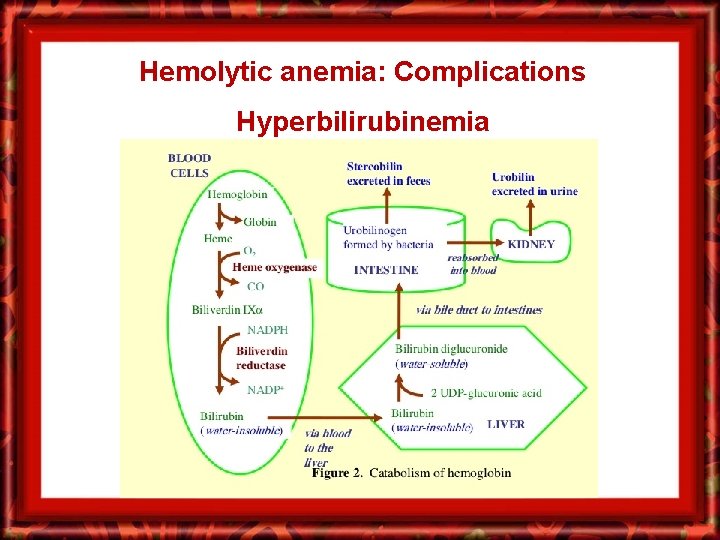 Hemolytic anemia: Complications Hyperbilirubinemia 