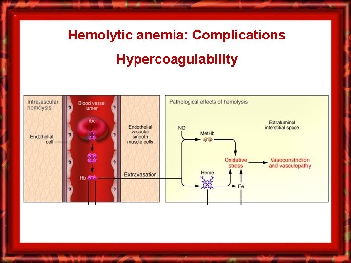 Hemolytic anemia: Complications Hypercoagulability 