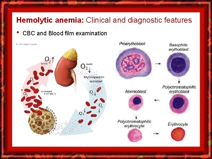 Hemolytic anemia: Clinical and diagnostic features • CBC and Blood film examination 