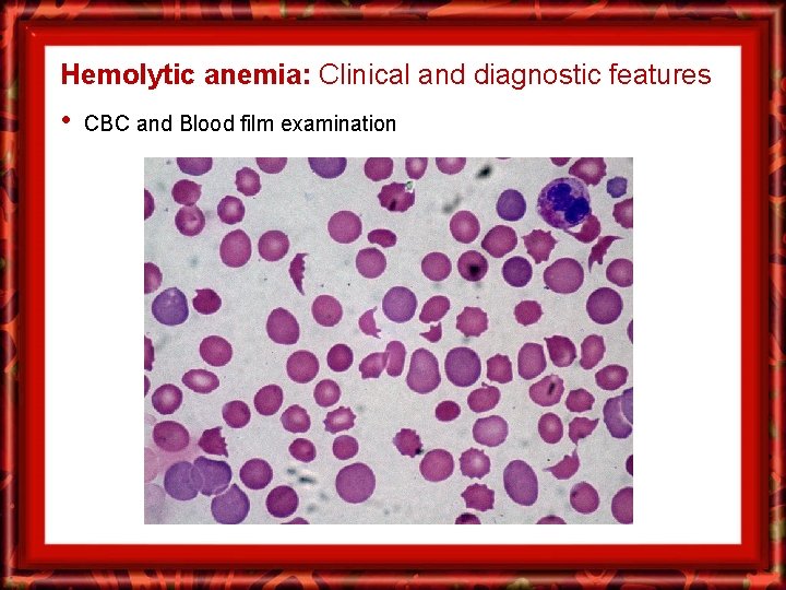Hemolytic anemia: Clinical and diagnostic features • CBC and Blood film examination 
