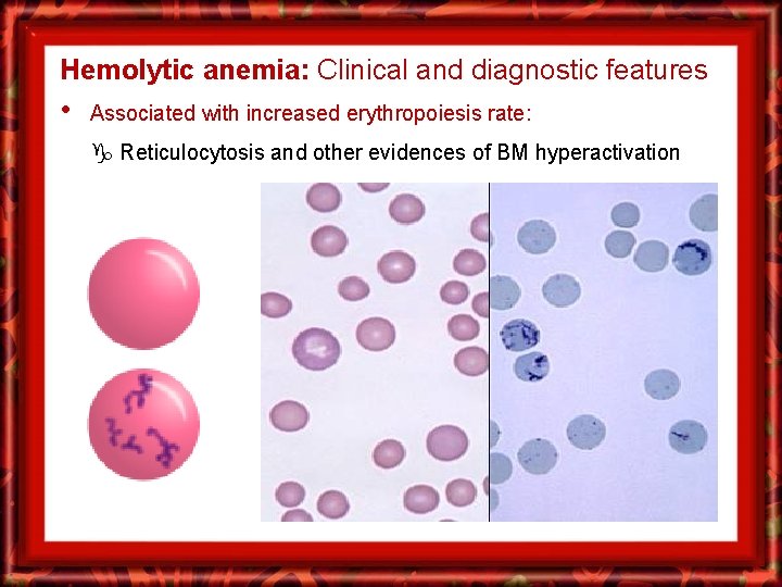 Hemolytic anemia: Clinical and diagnostic features • Associated with increased erythropoiesis rate: Reticulocytosis and
