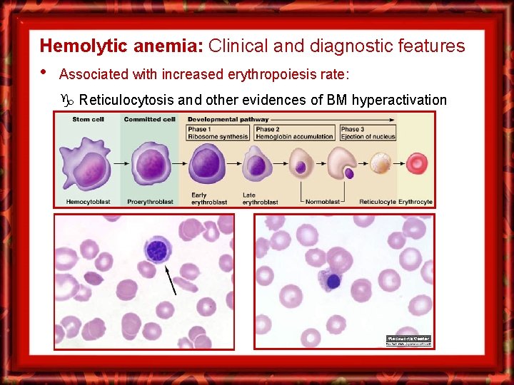 Hemolytic anemia: Clinical and diagnostic features • Associated with increased erythropoiesis rate: Reticulocytosis and