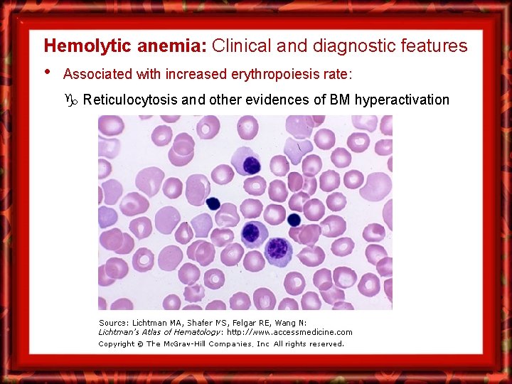 Hemolytic anemia: Clinical and diagnostic features • Associated with increased erythropoiesis rate: Reticulocytosis and