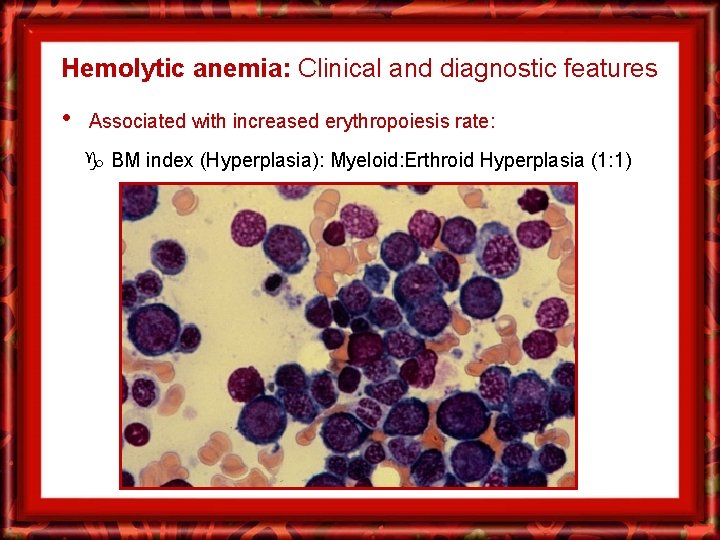 Hemolytic anemia: Clinical and diagnostic features • Associated with increased erythropoiesis rate: BM index