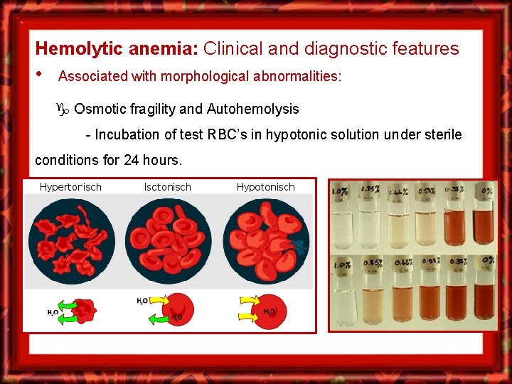 Hemolytic anemia: Clinical and diagnostic features • Associated with morphological abnormalities: Osmotic fragility and