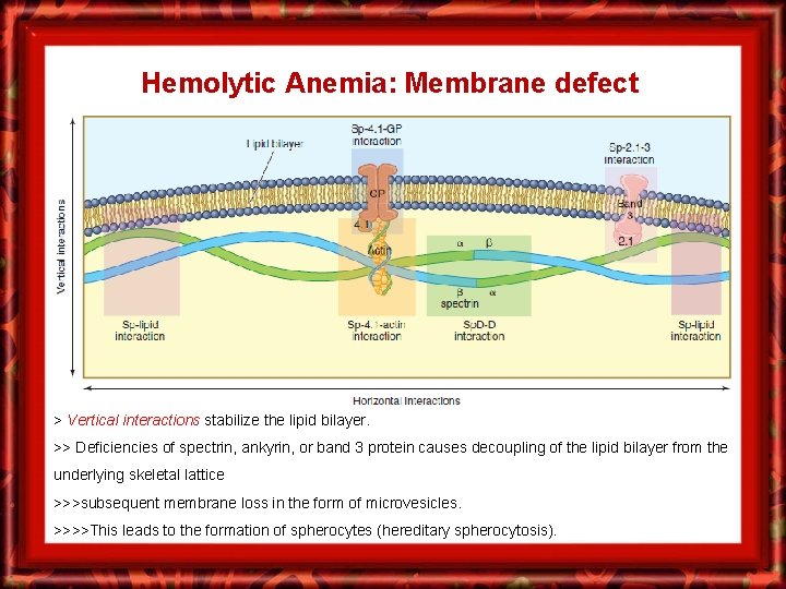 Hemolytic Anemia: Membrane defect > Vertical interactions stabilize the lipid bilayer. >> Deficiencies of