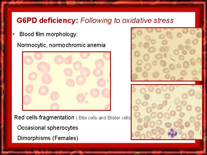 G 6 PD deficiency: Following to oxidative stress • Blood film morphology: Normocytic, normochromic
