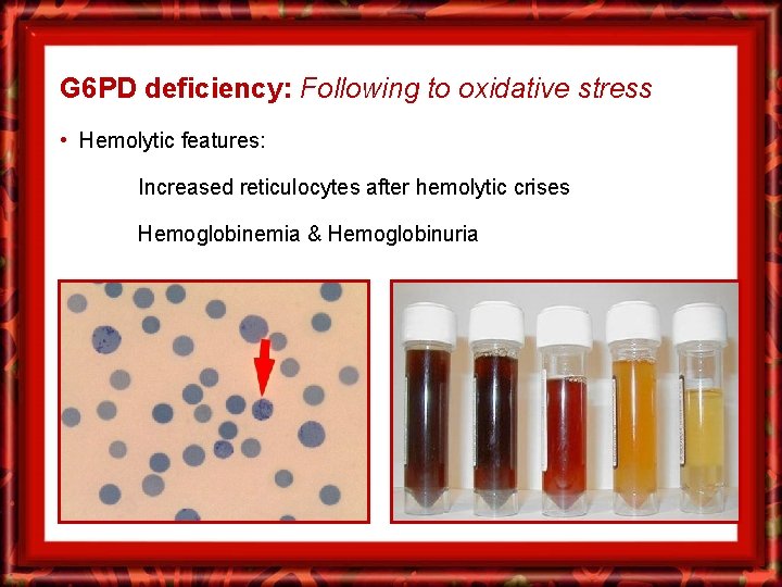 G 6 PD deficiency: Following to oxidative stress • Hemolytic features: Increased reticulocytes after