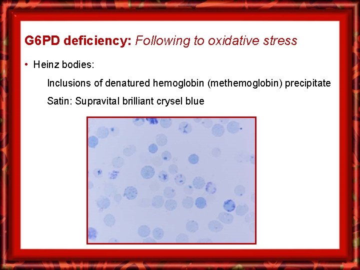 G 6 PD deficiency: Following to oxidative stress • Heinz bodies: Inclusions of denatured