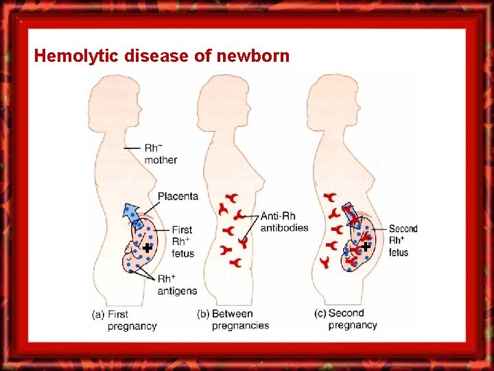 Hemolytic disease of newborn 