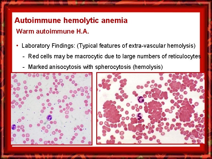 Autoimmune hemolytic anemia Warm autoimmune H. A. • Laboratory Findings: (Typical features of extra-vascular