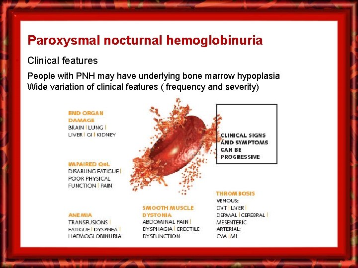 Paroxysmal nocturnal hemoglobinuria • Clinical features People with PNH may have underlying bone marrow